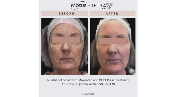 Mǒtus Laser Hair Removal + Tetra Pro - Are you searching for cutting-edge, effective, and comfortable solutions to rejuvenate your appearance? Discover the future of laser skincare at Rejuvenate U Medical Spa — Pensacola’s trusted destination for the latest in non-surgical beauty with Mǒtus + Tetra Pro treatments!
✨ Why Mǒtus + Tetra Pro? The Ultimate in Laser Innovation!
• Mǒtus is an industry-leading laser for PAINLESS, highly effective hair removal—safe for ALL skin types, even tanned skin, all year long! Say goodbye to unwanted hair and ingrowns with sessions that are fast, comfortable, and give you smooth, beautiful skin.
• Tetra Pro is Pensacola’s premier laser skin resurfacing technology — the next evolution in laser treatments for brighter, smoother, and more youthful skin. Whether you want to treat fine lines, wrinkles, pigmentation, acne scars, or overall texture and tone, Tetra Pro delivers dramatic results with minimal discomfort and downtime.
🌟 What Can You Achieve with Mǒtus + Tetra Pro at Rejuvenate U?
• Virtually Painless Laser Hair Removal
• Revitalized Skin Tone and Texture
• Minimized Pores, Fine Lines & Wrinkles
• Sun Damage & Pigmentation Reversal
• Reduced Acne Scarring
• Rejuvenated, Confident You!
Our team of skilled professionals will design a fully customized plan using these world-class devices, so you can safely and comfortably reach your beauty goals.
💖 Why Choose Rejuvenate U?
• Board-certified medical aesthetics team
• State-of-the-art technology, superior results
• Private, luxury treatment rooms
• Personalized, attentive approach
• Complimentary consultations
✨ Whether it’s silky-smooth skin or a luminous, youthful glow, Rejuvenate U is your partner on the path to extraordinary confidence.
Ready to Get Started?
📞 Call us today at (850) 964-1820 to schedule your FREE consultation, learn about our Mǒtus + Tetra Pro packages, and ask about our seasonal specials! Mǒtus Laser Hair Removal + Tetra Pro - Are you searching for cutting-edge, effective, and comfortable solutions to rejuvenate your appearance? Discover the future of laser skincare at Rejuvenate U Medical Spa — Pensacola’s trusted destination for the latest in non-surgical beauty with Mǒtus + Tetra Pro treatments!
✨ Why Mǒtus + Tetra Pro? The Ultimate in Laser Innovation!
• Mǒtus is an industry-leading laser for PAINLESS, highly effective hair removal—safe for ALL skin types, even tanned skin, all year long! Say goodbye to unwanted hair and ingrowns with sessions that are fast, comfortable, and give you smooth, beautiful skin.
• Tetra Pro is Pensacola’s premier laser skin resurfacing technology — the next evolution in laser treatments for brighter, smoother, and more youthful skin. Whether you want to treat fine lines, wrinkles, pigmentation, acne scars, or overall texture and tone, Tetra Pro delivers dramatic results with minimal discomfort and downtime.
🌟 What Can You Achieve with Mǒtus + Tetra Pro at Rejuvenate U?
• Virtually Painless Laser Hair Removal
• Revitalized Skin Tone and Texture
• Minimized Pores, Fine Lines & Wrinkles
• Sun Damage & Pigmentation Reversal
• Reduced Acne Scarring
• Rejuvenated, Confident You!
Our team of skilled professionals will design a fully customized plan using these world-class devices, so you can safely and comfortably reach your beauty goals.
💖 Why Choose Rejuvenate U?
• Board-certified medical aesthetics team
• State-of-the-art technology, superior results
• Private, luxury treatment rooms
• Personalized, attentive approach
• Complimentary consultations
✨ Whether it’s silky-smooth skin or a luminous, youthful glow, Rejuvenate U is your partner on the path to extraordinary confidence.
Ready to Get Started?
📞 Call us today at (850) 964-1820 to schedule your FREE consultation, learn about our Mǒtus + Tetra Pro packages, and ask about our seasonal specials!