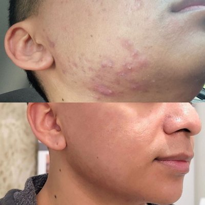 Acne Annihilators: Unleashing the Triumphant Trio for Flawless Skin! - Break Free from Acne Woes at Mara's Med Spa!
Struggling with stubborn acne? We've got the winning trio to defeat those pesky breakouts!
💥 AC Dual Acne Treatment: Bye-Bye Bacteria, Hello Clear Skin!
Wave goodbye to acne-causing bacteria and bid adieu to inflammation. Our AC Dual Acne Treatment targets the root causes of breakouts, giving you the confidence to show off your flawless complexion.
✨ Venus Viva: Your Secret Weapon Against Acne Scarring!
Unleash the power of customizable microneedling RF with Venus Viva. Say goodbye to acne scars and uneven texture as we resurface your skin. Get ready to reveal the smooth, radiant skin you've always dreamed of!
🌟 Microdermabrasion: Revive Your Skin's Youthful Glow!
Experience the magic of gentle exfoliation with Microdermabrasion. Watch as it gently sweeps away dead skin cells, leaving your skin vibrant, rejuvenated, and oh-so-youthful. Embrace a complexion that turns heads!
Ready to embark on your acne-fighting journey? Call Mara's Med Spa now to schedule your FREE consultation. Our experts are here to guide you towards clear, beautiful skin.
📞 Don't wait! Pick up the phone and take that first step towards a brighter future. Let your skin be a testament to your confidence! 469-730-3333 Acne Annihilators: Unleashing the Triumphant Trio for Flawless Skin! - Break Free from Acne Woes at Mara's Med Spa!
Struggling with stubborn acne? We've got the winning trio to defeat those pesky breakouts!
💥 AC Dual Acne Treatment: Bye-Bye Bacteria, Hello Clear Skin!
Wave goodbye to acne-causing bacteria and bid adieu to inflammation. Our AC Dual Acne Treatment targets the root causes of breakouts, giving you the confidence to show off your flawless complexion.
✨ Venus Viva: Your Secret Weapon Against Acne Scarring!
Unleash the power of customizable microneedling RF with Venus Viva. Say goodbye to acne scars and uneven texture as we resurface your skin. Get ready to reveal the smooth, radiant skin you've always dreamed of!
🌟 Microdermabrasion: Revive Your Skin's Youthful Glow!
Experience the magic of gentle exfoliation with Microdermabrasion. Watch as it gently sweeps away dead skin cells, leaving your skin vibrant, rejuvenated, and oh-so-youthful. Embrace a complexion that turns heads!
Ready to embark on your acne-fighting journey? Call Mara's Med Spa now to schedule your FREE consultation. Our experts are here to guide you towards clear, beautiful skin.
📞 Don't wait! Pick up the phone and take that first step towards a brighter future. Let your skin be a testament to your confidence! 469-730-3333