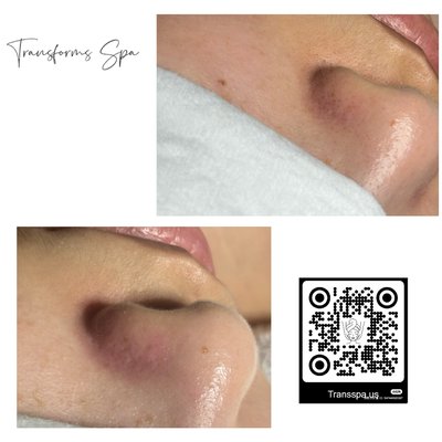 Say goodbye to blackheads, hello to clear skin. - Blackheads not only make the skin appear dull and rough but can also clog pores. Through professional deep cleansing and blackhead removal treatments, pores are thoroughly unclogged, leaving the skin smooth and refined. After cleansing, your skin looks more radiant, free from stubborn blackheads, and glowing with healthy vibrance. Let your skin return to its fresh, flawless beauty. Say goodbye to blackheads, hello to clear skin. - Blackheads not only make the skin appear dull and rough but can also clog pores. Through professional deep cleansing and blackhead removal treatments, pores are thoroughly unclogged, leaving the skin smooth and refined. After cleansing, your skin looks more radiant, free from stubborn blackheads, and glowing with healthy vibrance. Let your skin return to its fresh, flawless beauty.
