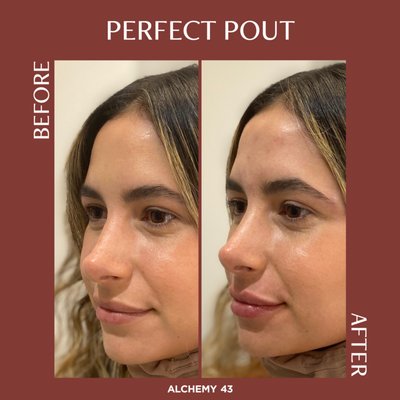 Filler Results - Plump, contour, define, and smooth with hyaluronic acid-based filler. Filler Results - Plump, contour, define, and smooth with hyaluronic acid-based filler.