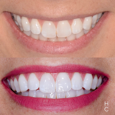 Teeth Whitening - A professional in-office teeth whitening is a customized experience at the Chicago Dental Studio. With techniques and products that offer dramatic results and minimal sensitivity to the teeth. Teeth Whitening - A professional in-office teeth whitening is a customized experience at the Chicago Dental Studio. With techniques and products that offer dramatic results and minimal sensitivity to the teeth.