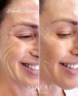 Wrinkle Relaxer - Rediscover a youthful, refreshed look with our personalized Wrinkle Relaxer treatments. Using Botox or Dysport, each session is artfully tailored to your unique facial anatomy for smooth, natural results that enhance your confidence and radiance. Wrinkle Relaxer - Rediscover a youthful, refreshed look with our personalized Wrinkle Relaxer treatments. Using Botox or Dysport, each session is artfully tailored to your unique facial anatomy for smooth, natural results that enhance your confidence and radiance.