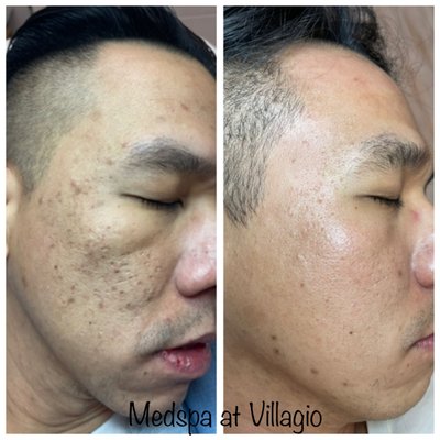 Before and after - Acne scars treatment Before and after - Acne scars treatment
