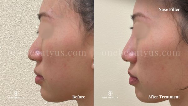 Nose Filler - Nose filler is a non-surgical cosmetic procedure for nasal reshaping using dermal fillers to temporarily correct mild to moderate irregularities. It is often used to smooth out bumps, lift a drooping tip, or improve overall nasal symmetry. A nose with uneven contours or lack of definition can affect the balance and harmony of facial features. When the nose lacks structure or appears asymmetrical, it can draw attention away from other areas of the face. Nose Filler - Nose filler is a non-surgical cosmetic procedure for nasal reshaping using dermal fillers to temporarily correct mild to moderate irregularities. It is often used to smooth out bumps, lift a drooping tip, or improve overall nasal symmetry. A nose with uneven contours or lack of definition can affect the balance and harmony of facial features. When the nose lacks structure or appears asymmetrical, it can draw attention away from other areas of the face.
