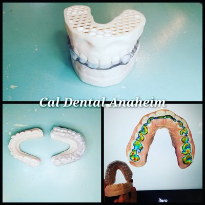 Night Guard - If you have sensitivity or jaw pain, this is caused by bruxism.
In this case, the plastic guard can help you to prevent further damage to your teeth.
3D-printed Night guard using an itero scanner will help you relieve sensitivity and Jaw pain.
If you have any questions, please call us (714) 828 0508
Cal Dental Anaheim
3006 W Lincoln Ave, Anaheim, CA 92801 Night Guard - If you have sensitivity or jaw pain, this is caused by bruxism.
In this case, the plastic guard can help you to prevent further damage to your teeth.
3D-printed Night guard using an itero scanner will help you relieve sensitivity and Jaw pain.
If you have any questions, please call us (714) 828 0508
Cal Dental Anaheim
3006 W Lincoln Ave, Anaheim, CA 92801