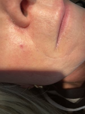 Cherry Angioma Removal - During an in home treatment, we successfully eliminated a cherry angioma on the face in just 90 seconds The result was perfection! Cherry Angioma Removal - During an in home treatment, we successfully eliminated a cherry angioma on the face in just 90 seconds The result was perfection!