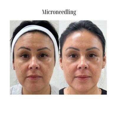 Microneedling - A minimally invasive cosmetic procedure designed to rejuvenate your skin from the inside out. By using tiny, sterilized needles to create micro-injuries in the skin, microneedling stimulates the body’s natural healing process. This boosts collagen and elastin production, which are essential for maintaining youthful, firm, and smooth skin.