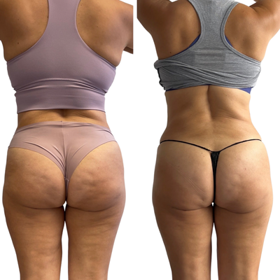 Cellulite Reduction Treatment - Summer = Bikinis 👙 A smooth Bum Bum and no cellulite 😱. Give us a call to find out how! Our Spring Special is almost over!
Summer is around the corner. Cellulite Reduction Treatment - Summer = Bikinis 👙 A smooth Bum Bum and no cellulite 😱. Give us a call to find out how! Our Spring Special is almost over!
Summer is around the corner.