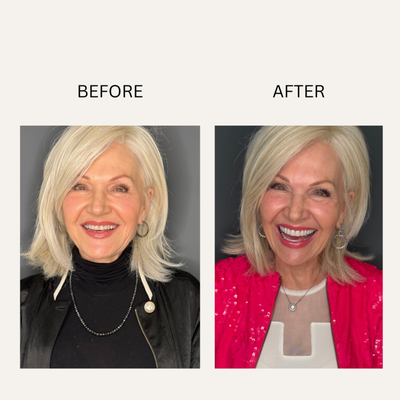 Porcelain Veneers - We go beyond Traditional Dental Care by Offering Extended Personalized 1:1 Appointments, depending on Your Unique Needs. Porcelain Veneers - We go beyond Traditional Dental Care by Offering Extended Personalized 1:1 Appointments, depending on Your Unique Needs.