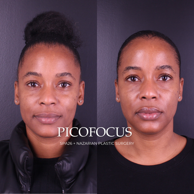 PicoFocus Laser: Before and After - PicoFocus® Skin Treatment is a non-invasive rejuvenation procedure using picosecond laser technology to treat specific skin concerns on the face and body. PicoFocus reduces the appearance of:

Acne Scarring
Age Spots
Surgical Scars
Stretch Marks
Melasma 
Rosacea
Fine Lines and Wrinkles
Compared to traditional laser treatments that use heat technology, PicoFocus uses precise wavelengths delivering rapid light pulses to remove hyperpigmentation and skin lesions gently. This picosecond laser technology stimulates the body’s natural healing response and avoids damage to surrounding tissues, making this treatment safe for all skin types, all year round. Results are visible after treatment, and minimal downtime is required.