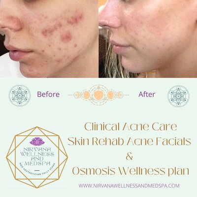 Clinical Acne Care with Osmosis Wellness - Clinical Acne Care utilizing Skin Mapping, Osmosis internal Wellness and Skin Rehab Acne Facials.
Get rid of Candida acne, preservative acne and hormonal acne! Clinical Acne Care with Osmosis Wellness - Clinical Acne Care utilizing Skin Mapping, Osmosis internal Wellness and Skin Rehab Acne Facials.
Get rid of Candida acne, preservative acne and hormonal acne!