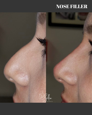 Nose, Cheek, Chin, and Jawline! - Over 20 years of combined clinical experience.
Every result you see here reflects that standard.
Selfie Aesthetic Miami, FL Nose, Cheek, Chin, and Jawline! - Over 20 years of combined clinical experience.
Every result you see here reflects that standard.
Selfie Aesthetic Miami, FL