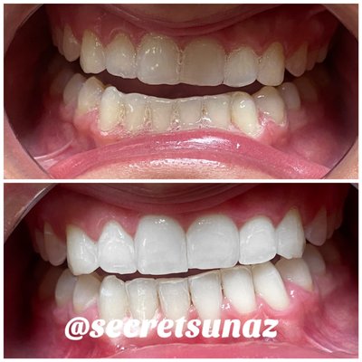 Organic teeth whitening - Our teeth whitening service use plant-based whitening serum in combination with an LED light. Without the harsh peroxide based whitening serums found in most whitening agents. Total process is 45minutes. Clients achieve an average of 3 shades whiter and without tooth sensitivity! Organic teeth whitening - Our teeth whitening service use plant-based whitening serum in combination with an LED light. Without the harsh peroxide based whitening serums found in most whitening agents. Total process is 45minutes. Clients achieve an average of 3 shades whiter and without tooth sensitivity!