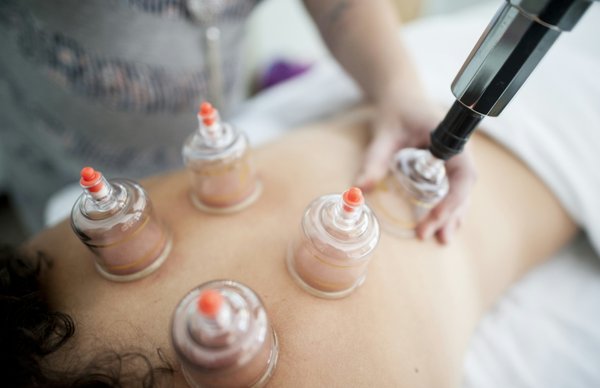 Cupping - Cupping has so many benefits! Call us today to learn how this treatment can impact your body. Cupping - Cupping has so many benefits! Call us today to learn how this treatment can impact your body.