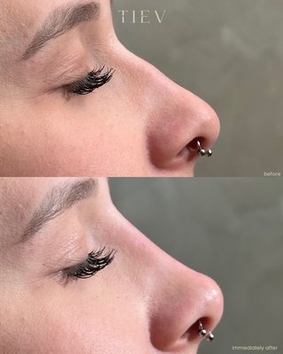Non-Surgical Nose Job - NON-SURGICAL NOSE JOB using hyaluronic acid filler! Quick and virtually painless. Appt time takes less than an hour! Non-Surgical Nose Job - NON-SURGICAL NOSE JOB using hyaluronic acid filler! Quick and virtually painless. Appt time takes less than an hour!
