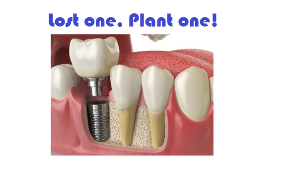 Implant Consult - Are you in need of implants ? Would you like to get a free consult, than come visit us today.