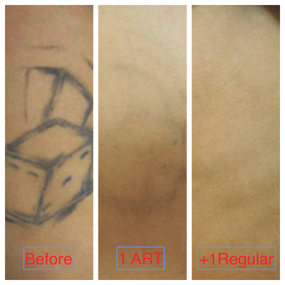 Tattoo Removal ART World's Fastest Removal - Zapatat has been providing safe, effective and affordable laser tattoo removal for 12 years and has done over 40,000 treatments. Zapatat has developed the worlds fastest tattoo removal. It's called Accelerated Removal Technique (ART) . Rather than 10-15 visits over 1-2 years, ART typically requires only 2-3 visits and 6-9 months to remove most tattoos. The overall cost is about the same as conventional treatments but the time savings are enormous. Tattoo Removal ART World's Fastest Removal - Zapatat has been providing safe, effective and affordable laser tattoo removal for 12 years and has done over 40,000 treatments. Zapatat has developed the worlds fastest tattoo removal. It's called Accelerated Removal Technique (ART) . Rather than 10-15 visits over 1-2 years, ART typically requires only 2-3 visits and 6-9 months to remove most tattoos. The overall cost is about the same as conventional treatments but the time savings are enormous.