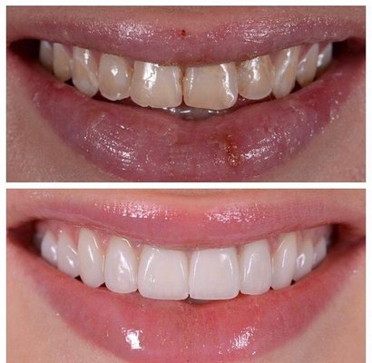 Veneers - Veneers before and after Veneers - Veneers before and after