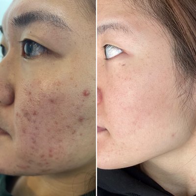 SKINPEN Microneedling & Aerolase Laser Treatment - SKINPEN Microneedling (Collagen Induction Therapy) utilizes fine, sterile needles to create tiny, controlled punctures in the skin’s surface. This process stimulates collagen and elastin production, leading to improved skin texture, reduced scarring, and a more youthful appearance. 


Aerolase laser is known for being gentle, versatile, and effective — especially for deeper skin tones and sensitive skin. It delivers energy with a 650-microsecond pulse, which makes it safer and more comfortable than traditional lasers.