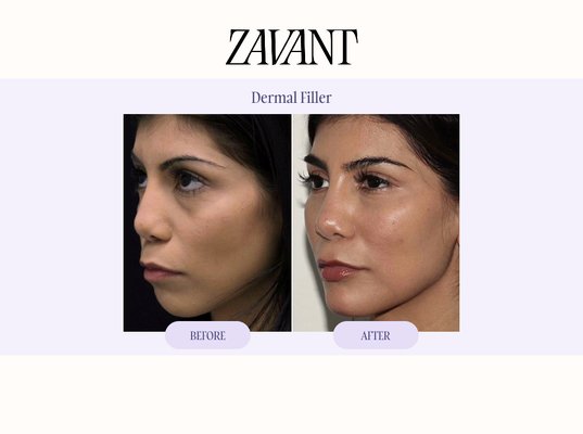 Dermal Filler - Explore dermal filler before & after results at Zavant Aesthetics. Dermal fillers can restore volume, enhance facial contours, improve symmetry, and create more balanced, natural-looking facial proportions.
Treatments may include the lips, cheeks, chin, jawline, and other areas depending on each patient’s anatomy and aesthetic goals. Every filler treatment at Zavant is personalized with a focus on facial balance and refined, natural-looking results. Dermal Filler - Explore dermal filler before & after results at Zavant Aesthetics. Dermal fillers can restore volume, enhance facial contours, improve symmetry, and create more balanced, natural-looking facial proportions.
Treatments may include the lips, cheeks, chin, jawline, and other areas depending on each patient’s anatomy and aesthetic goals. Every filler treatment at Zavant is personalized with a focus on facial balance and refined, natural-looking results.