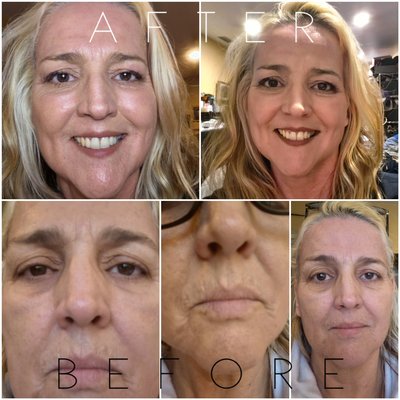 Fibroblast Plasma Skin Tightening - What’s the science behind this procedure?
Fibroblast Skin Tightening is a cosmetic skin treatment
that utilizes heat energy delivered through a small needle
with an electrical arch to create a controlled trauma
to the skin, in turn stimulating the bodies regeneration
which releases growth factors producing new collagen.
Collagen is the “glue” that holds the entire body together.
The body produces collagen naturally and it has
abundance when young, but unfortunately production
starts to decline at about age 25, and continues.
It decreases even more in women after menopause.
Fibroblasts are cells in your skin that create collagen.
The production of new collagen fibers form tighter skin
in the treatment area. Results last for 2- 6 years. Fibroblast Plasma Skin Tightening - What’s the science behind this procedure?
Fibroblast Skin Tightening is a cosmetic skin treatment
that utilizes heat energy delivered through a small needle
with an electrical arch to create a controlled trauma
to the skin, in turn stimulating the bodies regeneration
which releases growth factors producing new collagen.
Collagen is the “glue” that holds the entire body together.
The body produces collagen naturally and it has
abundance when young, but unfortunately production
starts to decline at about age 25, and continues.
It decreases even more in women after menopause.
Fibroblasts are cells in your skin that create collagen.
The production of new collagen fibers form tighter skin
in the treatment area. Results last for 2- 6 years.