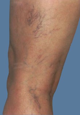 Before & After of Spider Vein Treatment - This patient had sever spider veins on her upper thigh. This is just one of our many exceptional results from sclerotherapy treatment. Call 714-955-5960 for details. Before & After of Spider Vein Treatment - This patient had sever spider veins on her upper thigh. This is just one of our many exceptional results from sclerotherapy treatment. Call 714-955-5960 for details.