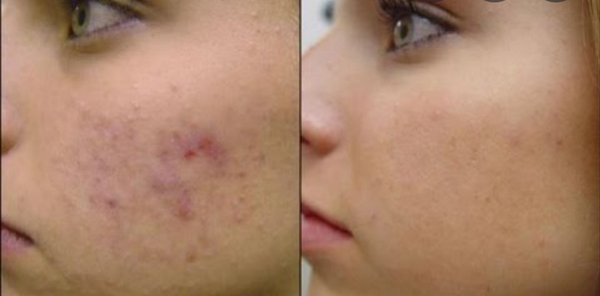 Glycolic acid peel - Acne scars gone with a glycolic peel, and vitamin c serum daily. Glycolic acid peel - Acne scars gone with a glycolic peel, and vitamin c serum daily.
