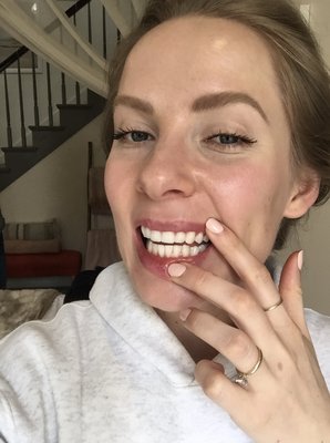 Teeth Whitening! - This teeth whitening treatment will remove surface stains, as well as remove the more penetrated staining by whitening deeper into the pores of the enamel.