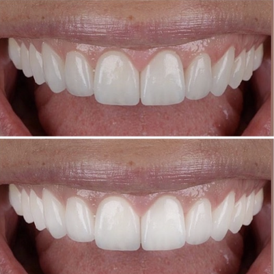 Teeth Whitening - Teeth Whitening Cases