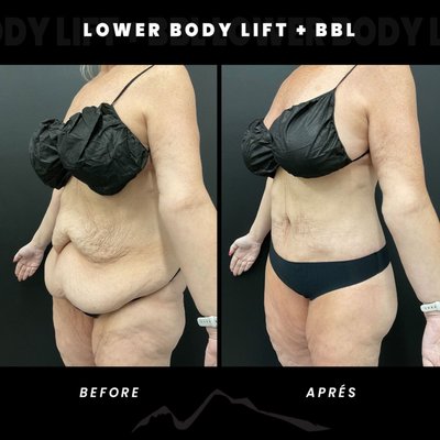 Lower Body Lift + BBL - Lower body lift + BBL performed by Board-certified Plastic Surgeon Dr. Aric Aghayan at Après Plastic Surgery in Portland Oregon Lower Body Lift + BBL - Lower body lift + BBL performed by Board-certified Plastic Surgeon Dr. Aric Aghayan at Après Plastic Surgery in Portland Oregon