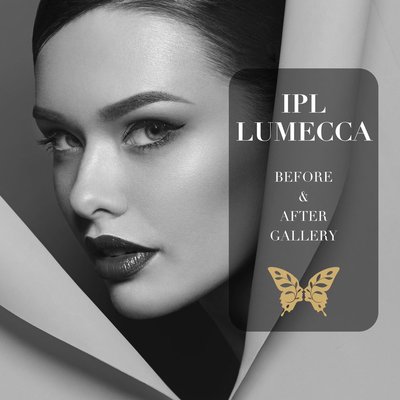 IPL Lumecca - An even skin tone is one of the surest signs of healthy and youthful skin. With aging, hypo- and hyperpigmentation become a concern for patients. Energy-based treatments, such as Lumecca, are the most effective means of restoring an even skin tone. Lumecca is a very powerful intense pulsed light (IPL) that treats pigmented and vascular lesions. After just one use, you will notice significant improvement in the complexion and clarity of your skin. Lumecca operates using photothermolysis, which delivers a comfortable and effective light treatment. IPL Lumecca - An even skin tone is one of the surest signs of healthy and youthful skin. With aging, hypo- and hyperpigmentation become a concern for patients. Energy-based treatments, such as Lumecca, are the most effective means of restoring an even skin tone. Lumecca is a very powerful intense pulsed light (IPL) that treats pigmented and vascular lesions. After just one use, you will notice significant improvement in the complexion and clarity of your skin. Lumecca operates using photothermolysis, which delivers a comfortable and effective light treatment.