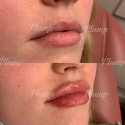 Lip Filler - Lip Filler is offered at Plump, the price ranges from $300 to $700 with our Expert Injectors. Lip Filler - Lip Filler is offered at Plump, the price ranges from $300 to $700 with our Expert Injectors.