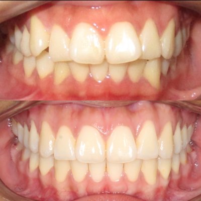 Invisalign Before and After - Invisalign Treatment done in less than 18 months. Invisalign Before and After - Invisalign Treatment done in less than 18 months.