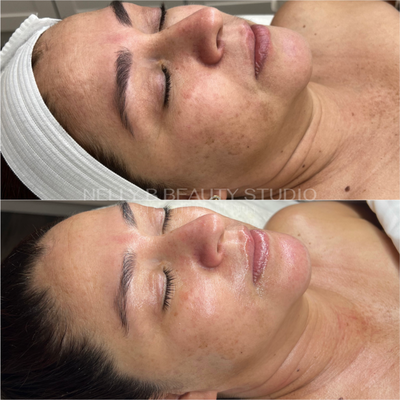 DMK RP Skin Revision - RP Treatment is a skin treatment that is capable of more than just reducing the signs of aging. This multi-layered treatment employs AHAs, BHAs, and Vitamin A to provide remarkable and transformative outcomes. It involves a multi-layered peel, but before undergoing this treatment, DMK Enzyme is required. Please note that results may vary.