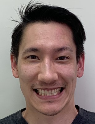 Invisalign Treatment without Extractions - This fantastic result was achieved using Invisalign aligners. Patient was told by prior dentists that he would need surgery and teeth extracted. However, we were able to provide excellent results non-invasively. Invisalign Treatment without Extractions - This fantastic result was achieved using Invisalign aligners. Patient was told by prior dentists that he would need surgery and teeth extracted. However, we were able to provide excellent results non-invasively.