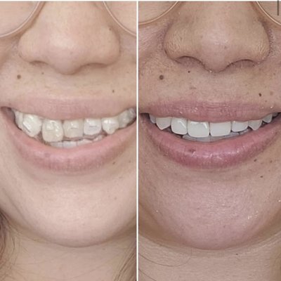 Before and after Anterior teeth Make over ! - Before and After images of Anterior teeth Zirconium crowns. Before and after Anterior teeth Make over ! - Before and After images of Anterior teeth Zirconium crowns.