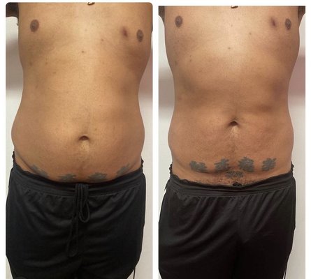 Body Sculpture and liposuction - Foot detox, noninvasive liposuction and body contouring These treatments show before and after pics Body Sculpture and liposuction - Foot detox, noninvasive liposuction and body contouring These treatments show before and after pics