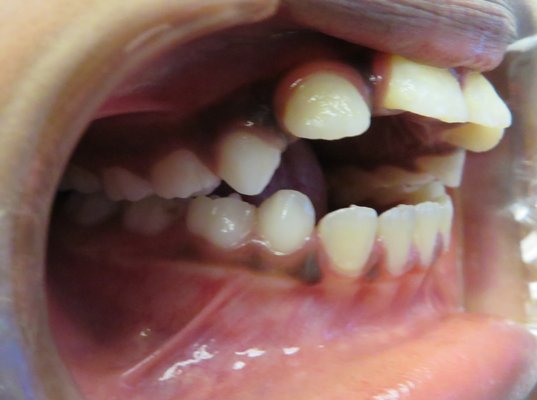 Thumb sucking habit appliance - We recently helped a young patient who was having a hard time breaking a thumb-sucking habit. We help patients of all ages break habits and align teeth.

At our visit, we talked through why the habit can affect growing teeth and jaw development, and worked together on a gentle, age-appropriate plan to help them stop. We also started a Phase 1 treatment to help correct the dentofacial developmental changes that had occurred due to the habit.