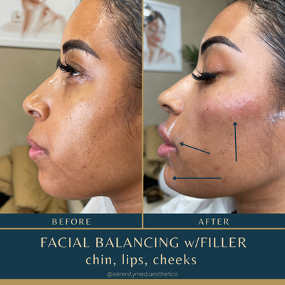 Fillers and Biostimulators - Dermal fillers provide a safe, non-surgical way to gently repair what may have weakened over time. We can help you regain your natural glow, whether you're looking for under-eye fillers to lighten weary eyes, lip fillers to improve your smile, Radiesse fillers to provide structure and lift, or a comprehensive filler approach to improve facial proportions and balance.