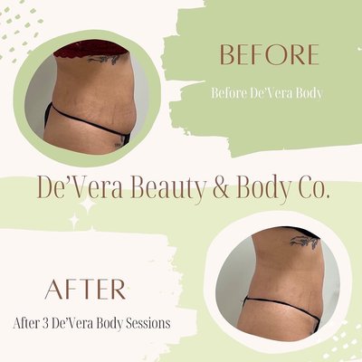 De’Vera Body Contouring - Before and after De’Vera Body Sculpting Sessions
