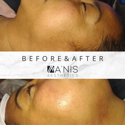 HydraFacial - HydraFacial super serums are made with nourishing ingredients that create an instantly gratifying glow in just 3 steps:

Cleanse + Peel
Uncover a new layer of skin with gentle exfoliation and relaxing resurfacing.

Extract + Hydrate
Remove debris from pores with painless suction. Nourish with intense moisturizers that quench skin.

Fuse + Protect
Saturate the skin’s surface with antioxidants and peptides to maximize your glow.