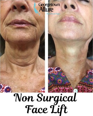 Non Surgical Face Lift - Georgetown Allure Medical Spa is excited to offer a groundbreaking new approach to aesthetic enhancement: the nonsurgical facelift and neck lift.
Using cutting-edge technologies, our team can smooth fine lines, enhance your skin's elasticity, and create added definition along the face, neck, and jawline — all without a single incision or scar. If you're looking for long-lasting rejuvenation without the need for surgery, we invite you to schedule a consultation at our Washington, D.C. medical spa to experience the future of cosmetic treatments. New client offer ONLY $125, regularly $600.
Schedule your complimentary phone consultation to learn more! Non Surgical Face Lift - Georgetown Allure Medical Spa is excited to offer a groundbreaking new approach to aesthetic enhancement: the nonsurgical facelift and neck lift.
Using cutting-edge technologies, our team can smooth fine lines, enhance your skin's elasticity, and create added definition along the face, neck, and jawline — all without a single incision or scar. If you're looking for long-lasting rejuvenation without the need for surgery, we invite you to schedule a consultation at our Washington, D.C. medical spa to experience the future of cosmetic treatments. New client offer ONLY $125, regularly $600.
Schedule your complimentary phone consultation to learn more!
