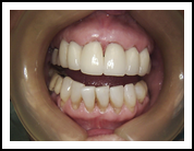 Redo old crowns - The patient did not like the original crowns, and it's easy to see why. I think the new ones came out rather well Redo old crowns - The patient did not like the original crowns, and it's easy to see why. I think the new ones came out rather well