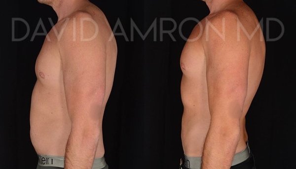 Liposuction - Natural Def Lipo™ is a highly advanced liposculpture surgery that precisely sculpts the body without compromising the skin’s elasticity or creating excessive scarring beneath the skin in efforts to create artificial definition. Natural Def Lipo, pioneered by Dr. Amron, is the missing factor in a body contouring world preoccupied by artificial definition, etching and imitation abs.
By utilizing his highly advanced technique, The Amron Method™ in combination with his extensive understanding of the skin, Dr. Amron can achieve maximum aesthetic enhancement without compromising factors that are usually neglected with High Def Liposuction. Natural Def Lipo™ is the key to attaining a natural-looking contour by enhancing the patient’s existing features rather than artificially creating what’s not there. Liposuction - Natural Def Lipo™ is a highly advanced liposculpture surgery that precisely sculpts the body without compromising the skin’s elasticity or creating excessive scarring beneath the skin in efforts to create artificial definition. Natural Def Lipo, pioneered by Dr. Amron, is the missing factor in a body contouring world preoccupied by artificial definition, etching and imitation abs.
By utilizing his highly advanced technique, The Amron Method™ in combination with his extensive understanding of the skin, Dr. Amron can achieve maximum aesthetic enhancement without compromising factors that are usually neglected with High Def Liposuction. Natural Def Lipo™ is the key to attaining a natural-looking contour by enhancing the patient’s existing features rather than artificially creating what’s not there.