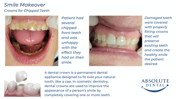Crowns for Chipped Teeth - Patient had several chipped front teeth and was unhappy with the effect they had on their smile.
Damaged teeth were covered with properly fitting crowns that will preserve existing teeth and create the healthy smile the patient desired. Crowns for Chipped Teeth - Patient had several chipped front teeth and was unhappy with the effect they had on their smile.
Damaged teeth were covered with properly fitting crowns that will preserve existing teeth and create the healthy smile the patient desired.