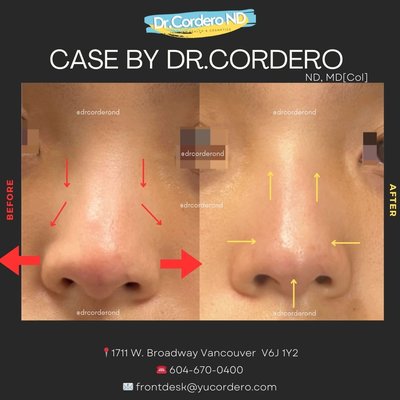 Before / After photos - Welcome to our curated collection of before-and-after cases by Dr. David Cordero, medical director and expert in facial reconstruction, lifting, and advanced aesthetic contouring. This portfolio showcases Dr. Cordero’s signature approach: enhancing natural beauty with precision, balance, and artistry—never overfilled, never artificial.
Dr. Cordero specializes in full-face rejuvenation with dermal fillers, structural lifting techniques, and precise shaping of key facial features such as the nose, chin, and lips. Each transformation reflects his deep understanding of facial anatomy and proportion, allowing him to restore youthful contours while honoring the patient’s unique features.
Natural, Harmonious, Youth-Preserving Results:
Every case in this portfolio is guided by one core philosophy: your best results should still look like you. Dr. Cordero’s work focuses on:
- Rejuvenating without distortion
- Enhancing structure while maintaining softness
- Respecting the natural lines and character of the face
- Supporting long-term facial balance and harmony
Instead of chasing trends or exaggerated features, Dr. Cordero emphasizes subtle refinement—lifting what has descended, restoring what has diminished, and shaping what enhances overall symmetry. The results are fresh, elegant, and effortlessly natural.
Expertise in Facial Reconstruction & Lifting:
Dr. Cordero is known for his ability to lift and reshape the face using strategic filler placement. His techniques improve:
- Mid-face volume and cheek structure
- Jawline contour and lower-face definition
- Tear trough and under-eye brightness
- Temple and forehead support
- Overall facial proportions and anti-aging structure
These methods create a visible lifting effect without surgery, while maintaining natural expression and movement.
Precision Sculpting of Nose, Chin & Lips:
Dr. Cordero’s work in sculpting the nose, chin, and lips is characterized by balance, elegance, and restraint. Each enhancement is designed to:
- Improve profile harmony
- Define structure without over-projection
- Enhance beauty without changing identity
Non-surgical rhinoplasty, chin augmentation, and lip enhancement are performed with meticulous detail to ensure smooth contours, refined lines, and stable long-term results.
Authentic Transformations, Real Patients:
The images in this portfolio represent real patients treated at Infinity Clinic. No filters, no distortion—just genuine outcomes achieved through expertise and artistry. These transformations demonstrate how small, strategic adjustments can create powerful improvements while preserving individuality. Before / After photos - Welcome to our curated collection of before-and-after cases by Dr. David Cordero, medical director and expert in facial reconstruction, lifting, and advanced aesthetic contouring. This portfolio showcases Dr. Cordero’s signature approach: enhancing natural beauty with precision, balance, and artistry—never overfilled, never artificial.
Dr. Cordero specializes in full-face rejuvenation with dermal fillers, structural lifting techniques, and precise shaping of key facial features such as the nose, chin, and lips. Each transformation reflects his deep understanding of facial anatomy and proportion, allowing him to restore youthful contours while honoring the patient’s unique features.
Natural, Harmonious, Youth-Preserving Results:
Every case in this portfolio is guided by one core philosophy: your best results should still look like you. Dr. Cordero’s work focuses on:
- Rejuvenating without distortion
- Enhancing structure while maintaining softness
- Respecting the natural lines and character of the face
- Supporting long-term facial balance and harmony
Instead of chasing trends or exaggerated features, Dr. Cordero emphasizes subtle refinement—lifting what has descended, restoring what has diminished, and shaping what enhances overall symmetry. The results are fresh, elegant, and effortlessly natural.
Expertise in Facial Reconstruction & Lifting:
Dr. Cordero is known for his ability to lift and reshape the face using strategic filler placement. His techniques improve:
- Mid-face volume and cheek structure
- Jawline contour and lower-face definition
- Tear trough and under-eye brightness
- Temple and forehead support
- Overall facial proportions and anti-aging structure
These methods create a visible lifting effect without surgery, while maintaining natural expression and movement.
Precision Sculpting of Nose, Chin & Lips:
Dr. Cordero’s work in sculpting the nose, chin, and lips is characterized by balance, elegance, and restraint. Each enhancement is designed to:
- Improve profile harmony
- Define structure without over-projection
- Enhance beauty without changing identity
Non-surgical rhinoplasty, chin augmentation, and lip enhancement are performed with meticulous detail to ensure smooth contours, refined lines, and stable long-term results.
Authentic Transformations, Real Patients:
The images in this portfolio represent real patients treated at Infinity Clinic. No filters, no distortion—just genuine outcomes achieved through expertise and artistry. These transformations demonstrate how small, strategic adjustments can create powerful improvements while preserving individuality.