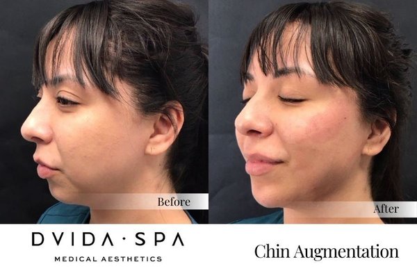 Chin Augmentation - At **Dvida Spa**, our expert Olga performs chin augmentation with dermal fillers to enhance facial balance and definition. The procedure offers immediate, natural-looking results without surgery, as seen in the photo, where the chin is more contoured and refined after treatment. This non-invasive option helps clients achieve a more balanced profile while maintaining a natural appearance. Chin Augmentation - At **Dvida Spa**, our expert Olga performs chin augmentation with dermal fillers to enhance facial balance and definition. The procedure offers immediate, natural-looking results without surgery, as seen in the photo, where the chin is more contoured and refined after treatment. This non-invasive option helps clients achieve a more balanced profile while maintaining a natural appearance.