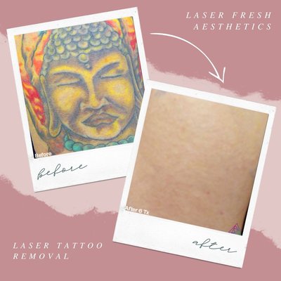 Before and After - Laser Fresh Aesthetics sets a new standard in tattoo removal in Santa Rosa. The Astanza Trinity is the cornerstone of their advanced approach, designed to cater to clients of all skin types and remove tattoos of any color with remarkable precision.

The Astanza Trinity’s distinguishing feature is its triple-wavelength versatility, with 1064 nm, 532 nm, and 694 nm laser beams that target a broad spectrum of tattoo pigments. This innovative technology is adept at removing even the most stubborn ink shades, making it the go-to choice for those looking to erase or modify their tattoos. The Astanza Trinity removes ink particles without causing harm to the surrounding skin tissue, resulting in a safe and pain-free experience for clients.