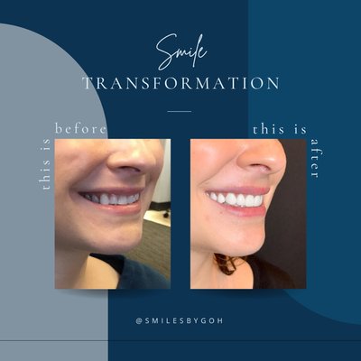 Smile Makeovers - Veneer cases done by Dr.Goh. Smile Makeovers - Veneer cases done by Dr.Goh.