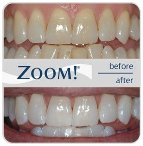 ZOOM! Teeth Whitening - If you want a whiter smile right now, or if you want to whiten your teeth more gradually over a longer period of time, we offer two options to brighten your smile through ZOOM! ZOOM! Teeth Whitening - If you want a whiter smile right now, or if you want to whiten your teeth more gradually over a longer period of time, we offer two options to brighten your smile through ZOOM!
